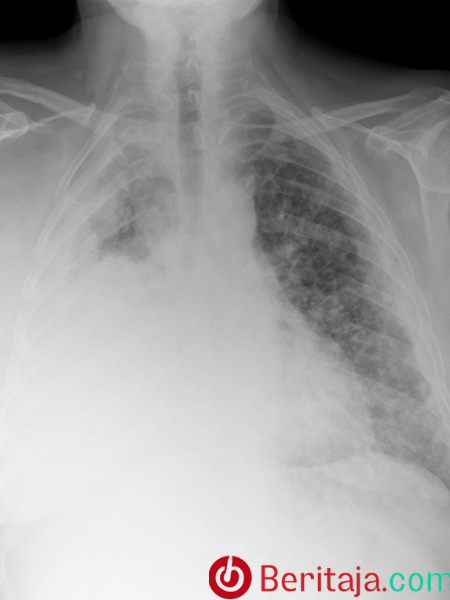 What+Are+the+Symptoms+of+Mesothelioma